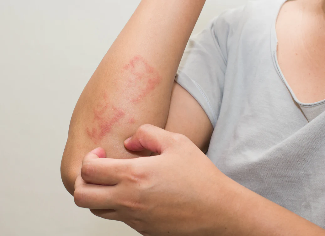 CBD za psoriazo: naravno lajšanje