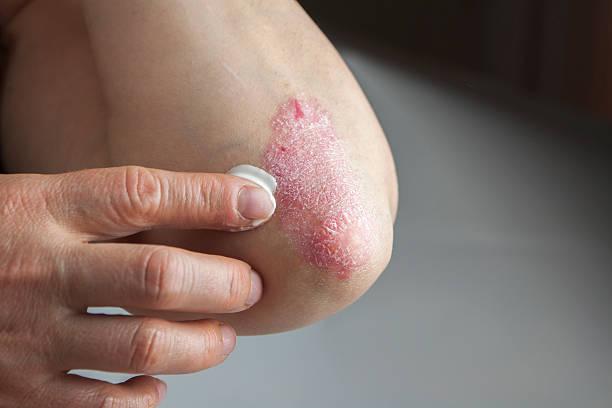 Atopični Dermatitis in potencialne Koristi CBD-ja in Konoplje: Raziskave in razumevanje